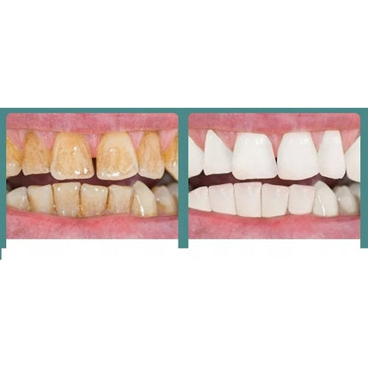 Scaler Ultrasonic Dentar cu LED – 3 Moduri Intensitate, 2 Capete Inox, Curățare Tartru & Placă Acasă